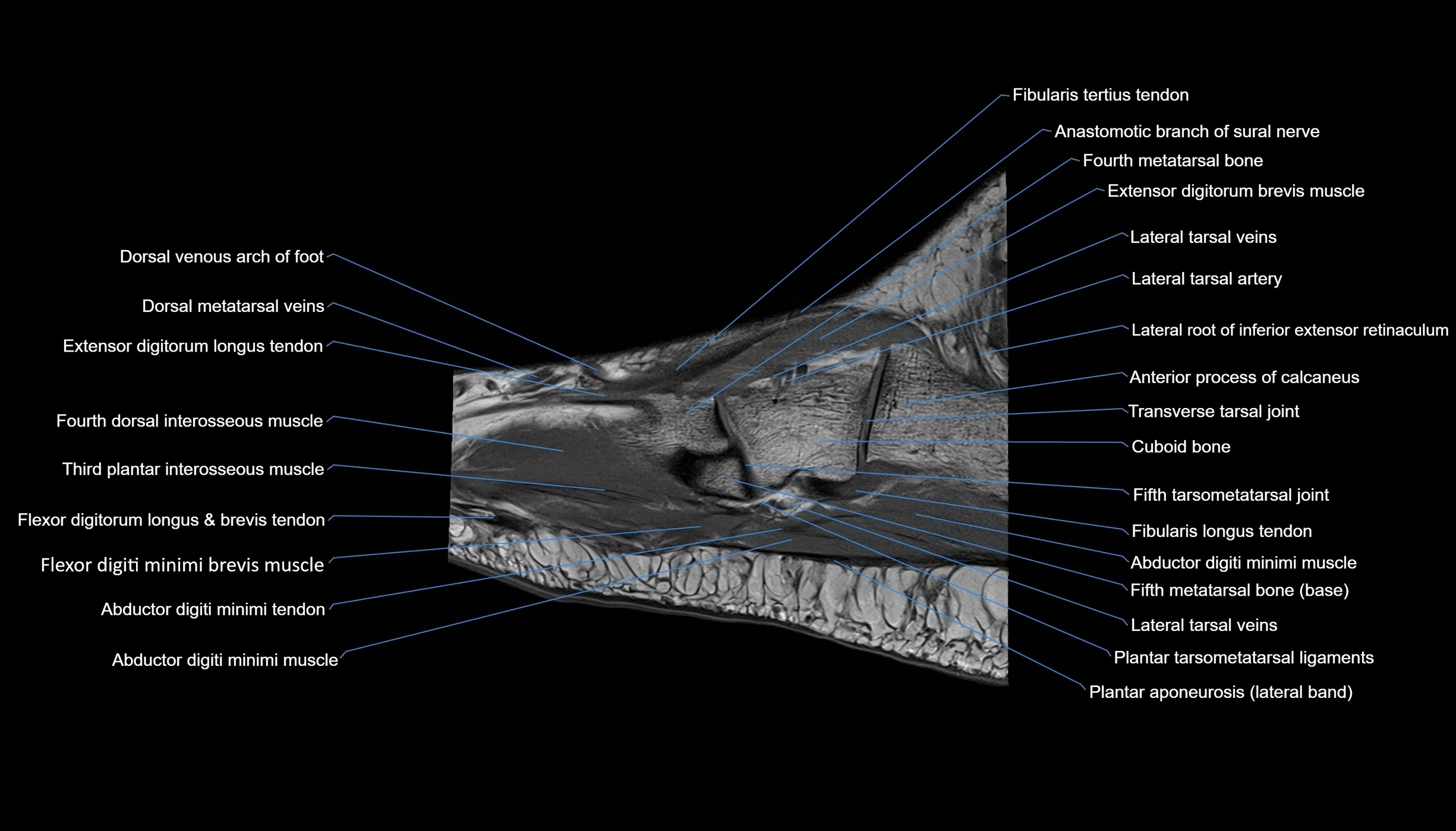 MRI mid foot sagittal cross sectional anatomy 3T  radiology  image-img-00001-00011.webp